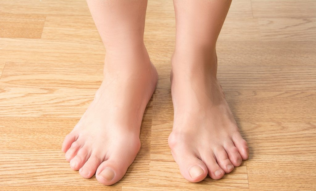 Natural Remedies for Bunions: What Works and What Doesnâ€™t?